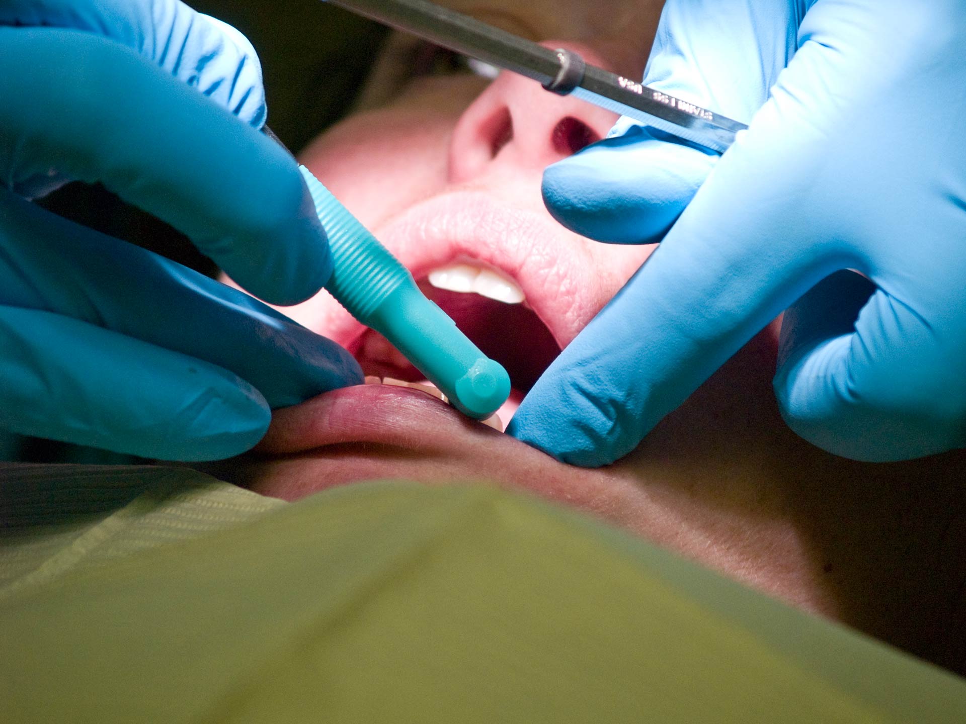 tratamento-canal Tratamento de canal