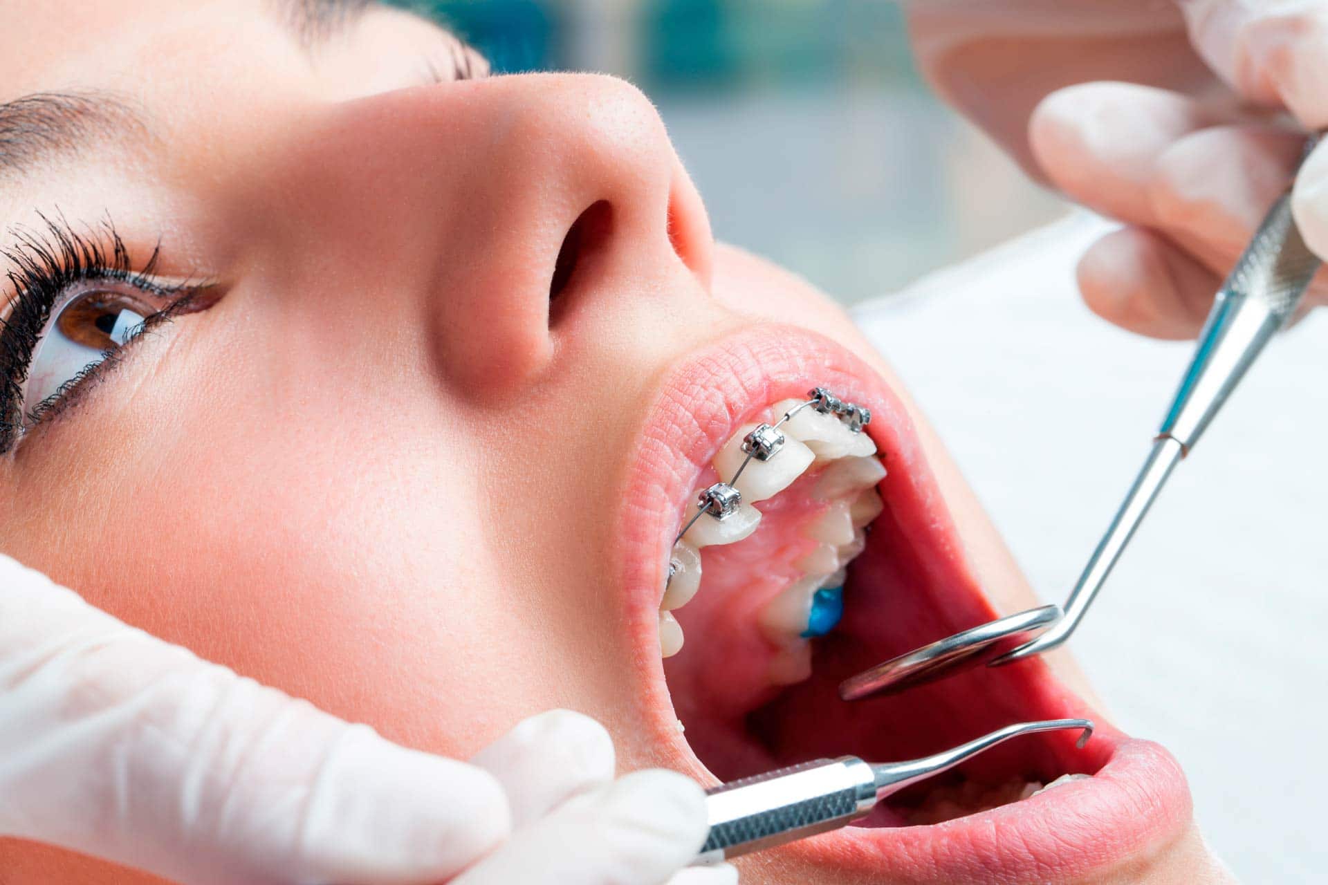 ortodontia - aparelho autoligavel 
