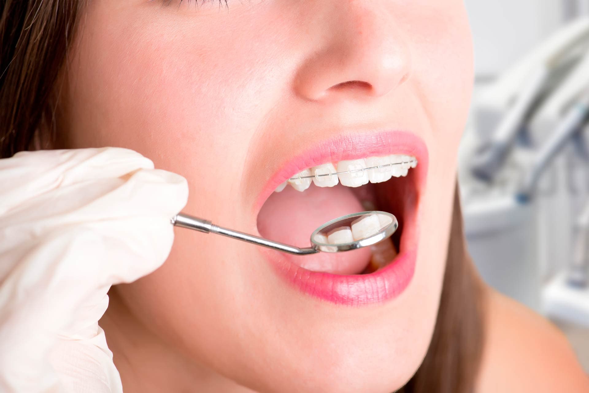 ortodontia - aparelho cerâmico 