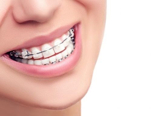 Quando se deve começar a utilizar aparelho odontológico?