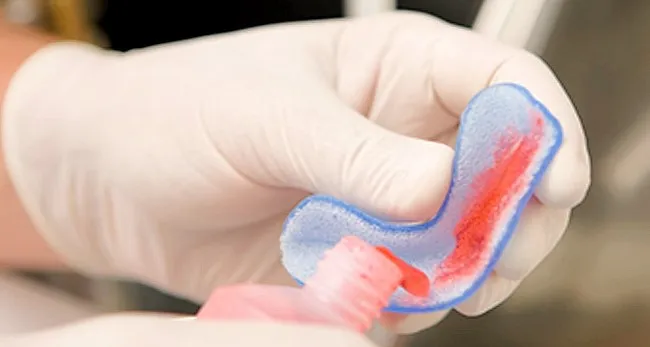 fluor_topico_moldeira Dentistica